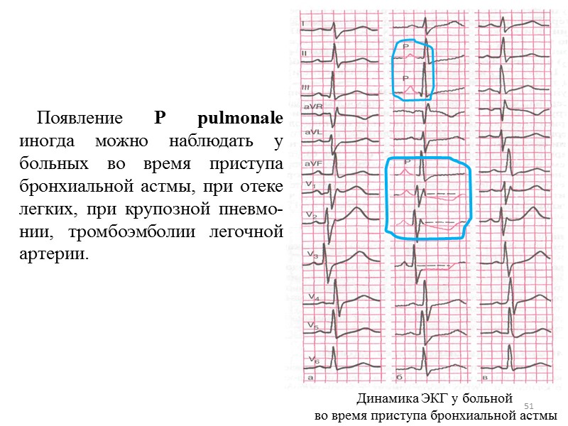 51 Появление Р pulmonale иногда можно наблюдать у больных 51 Появление Р pulmonale иногда можно наблюдать у больных